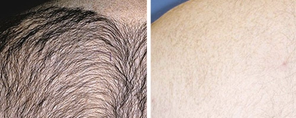 Laser Hair Removal Albany 1