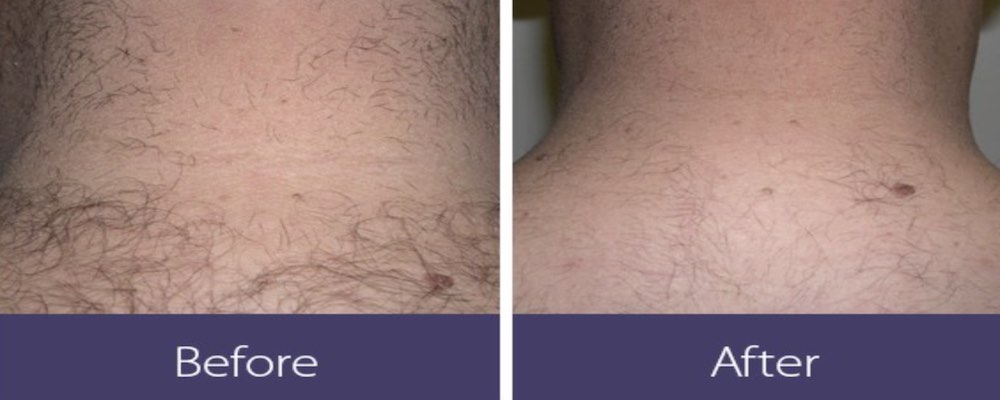 Laser Hair Removal Albany 2